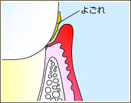 歯肉炎