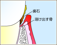 軽度歯周炎