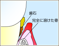 重度歯周病