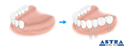 インプラント治療
