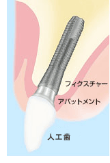 インプラント治療とは